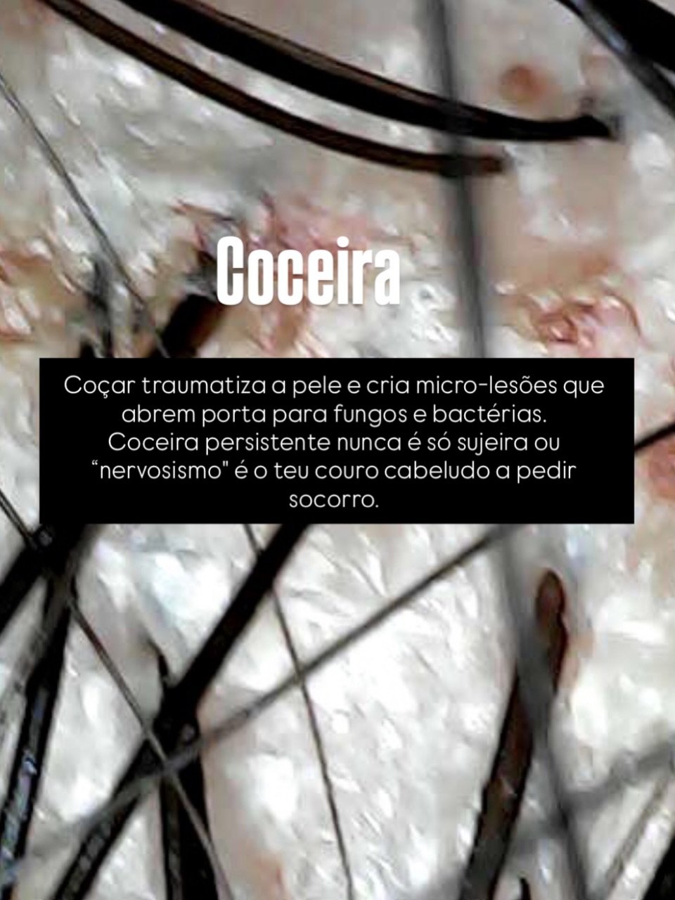 Descamação do couro cabeludo — sinal de alerta